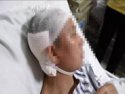 Người phụ nữ bị “khoan thủng” màng nhĩ, suýt chết vì viêm tai giữa, nguyên nhân xuất phát từ hành động chủ quan khi gội đầu
